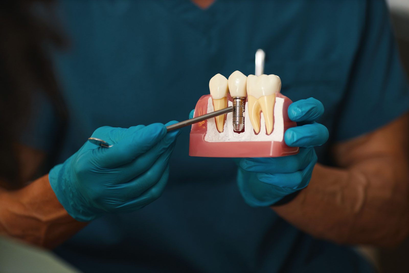 Impianti dentali: trattamento di implantologia